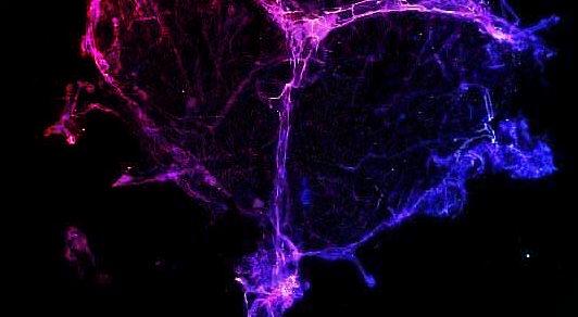 A kemoterápia mellékhatása lehet az agyi köd valódi oka