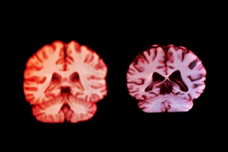 Miért nem védettebbek a nők az Alzheimer-kórral szemben időskorban