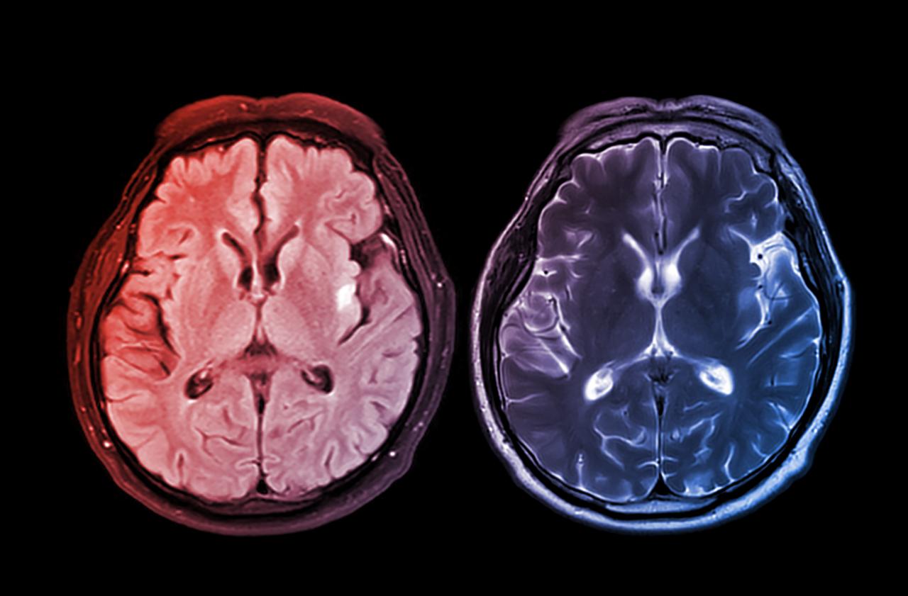 Az agyad öregedhetett a járványtól, ha nem is voltál beteg
