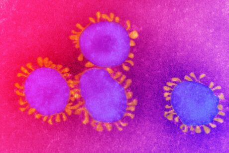 Az anyai COVID-fertőzés növelheti az autizmus kockázatát