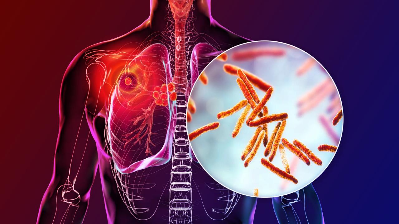 Az új csodagyógyszer áttörheti a tuberkulózis védelmét