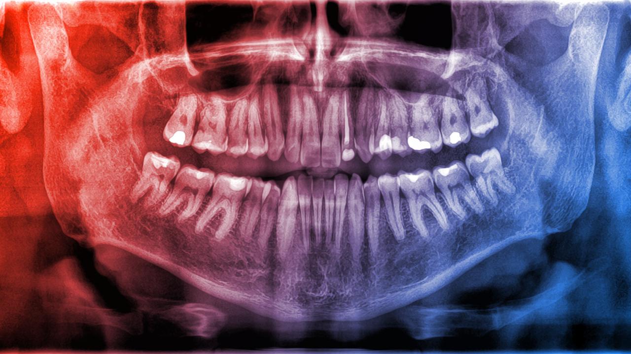 Miért nem számítanak a fogak csontnak, itt az igazság