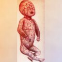 Az arc nélküli babák ritka bőrbetegsége: a harlequin ichthyosis