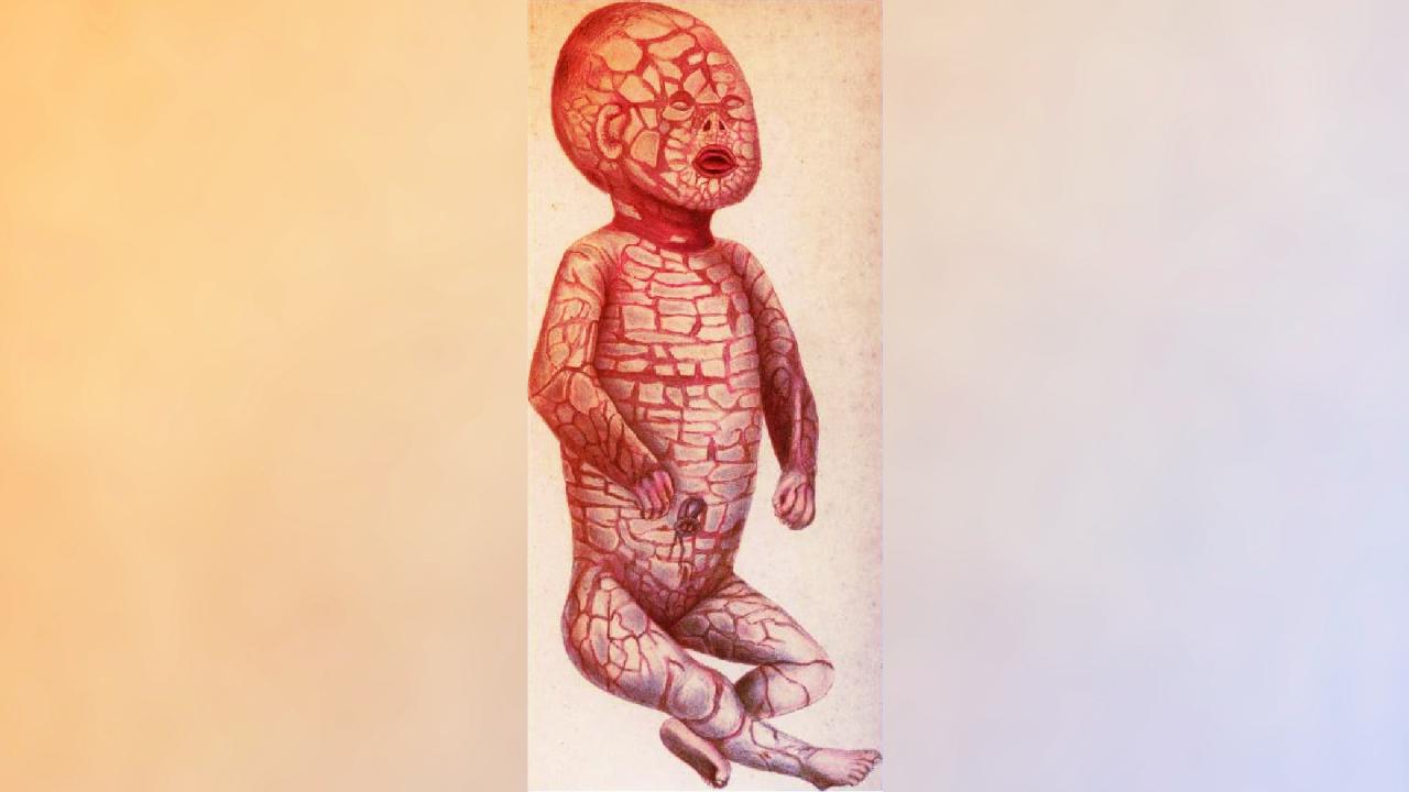 Az arc nélküli babák ritka bőrbetegsége: a harlequin ichthyosis
